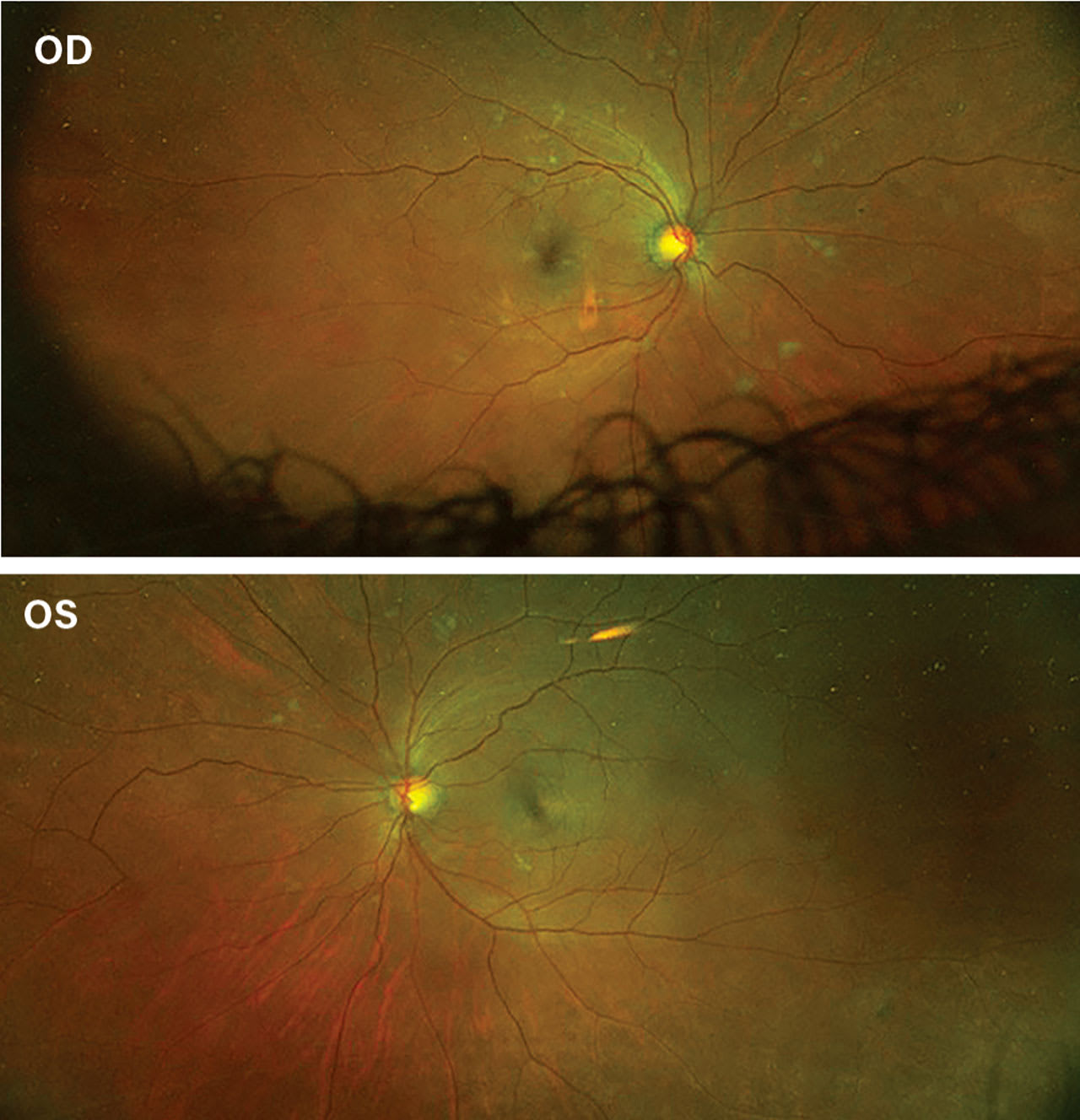 Note the increased cotton-wool spots OD and the retinal hemorrhages now visible OU.