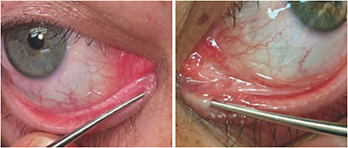 Figure 1. At left, right lower nasolacrimal stenosis is evidenced by the position of the punctal dilator compared to that of the left lower puncta. Despite firm pressure, the tip of the dilator fails to fully enter the inferior canaliculus. At right, the left lower puncta and canaliculus is patent, evidenced by deep position of dilator tip and classic optimal conjunctival blanching. 
Images courtesy of Dr. Steel
