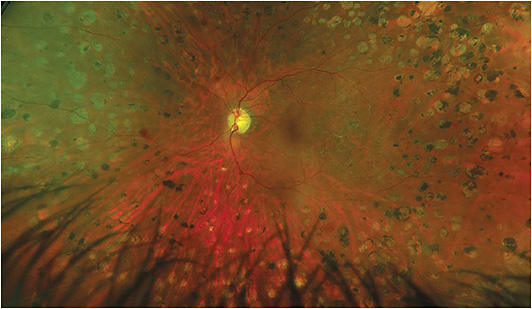 Impress with images: Here's diabetic retinopathy post-pan retinal photocoagulation with residual retinal hemorrhages and secondary chorio-retinal scars. Image courtesy of Chris Wroten, O.D.