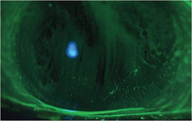Corneal staining seen in moderate DED. Photos courtesy of Dr. Tracy Doll.