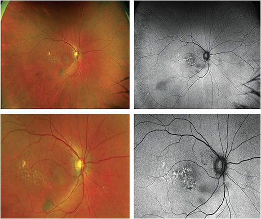 Figure 4. Autofluorescence (optomap af) revealed small, whitish spots indicative of oxidative stress.