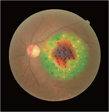IMAGE: Age-related macular degeneration (geographic atrophy)