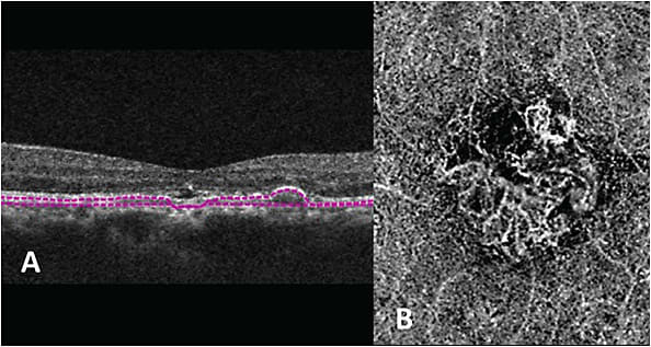 Image A: A 69-year-old patient with exudative AMD CNV. Image B: OCTA of the vascularized CNV.
Courtesy of Mohammad Rafieetary, O.D., F.A.A.O.