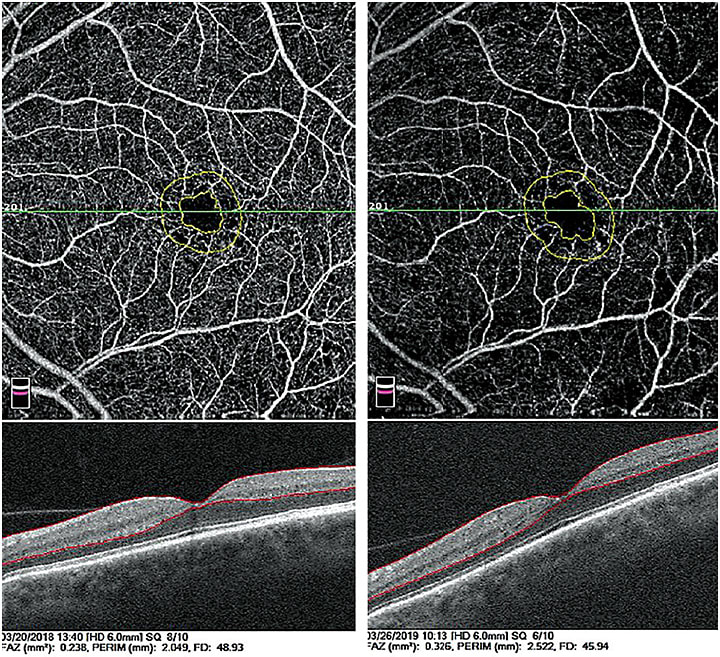 Figure 3. OCT-A showing enlargement of foveal avascular zone in an uncontrolled diabetic over a one-year period. Images courtesy of Dr. Michael Cymbor.