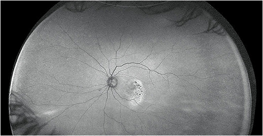 By diagnosing AMD early, we can determine early interventions. Image courtesy of Dr. Mark Roark.