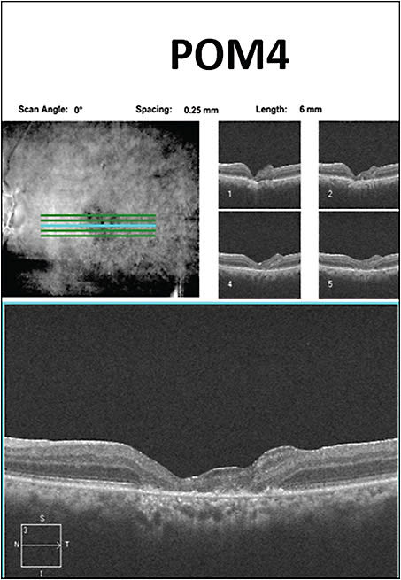 Figure 5. Optical coherence tomography at 4 months after retinal patch graft surgery showing stable closed macular hole in a 64-year-old male.