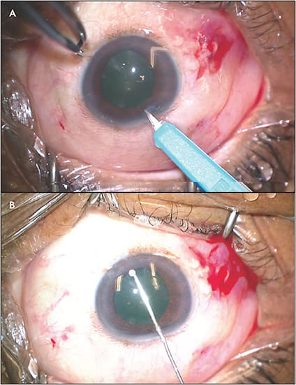 Figure 1. In a phakic patient undergoing vitreoretinal surgery, a paracentesis is created at the conclusion of surgery (A). A 27-gauge cannula is used to inject intracameral dexamethasone under the iris, then withdrawn (B). The spherule of drug remaining in the anterior chamber will dissolve within 14 days.