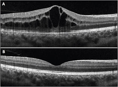 Figure 6. A 16-year-old female with idiopathic panuveitis in both eyes and persistent macular edema in the right eye despite 4 times daily topical difluprednate and 25 mg methotrexate (A). The macular edema resolved 5.5 weeks after starting adalimumab.
COURTESY OF ANGELA BESSETTE, MD.
