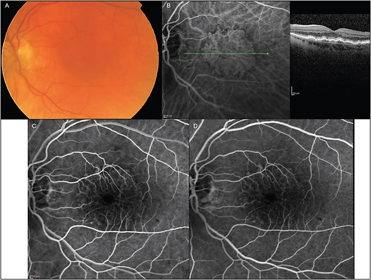Figure 1.  A 77-year-old female with exudative AMD in her right eye. The fellow eye presented with a nonexudative macular neovascularization. Color fundus photograph, with no ophthalmoscopically visible signs of choroidal neovascularization (A). Indocyanine green angiography at 2:56 minutes, showing a well-delineated plaque, consistent with macular neovascularization (B, left). Structural optical coherence tomography section through the plaque, showing a shallow, irregular elevation of the retinal pigment epithelium (B, right). The retina overlying the RPE is normal, and there is no evidence of fluid leakage. The fluorescein angiography frames at 45 seconds (C) and 1 minute (D) show some faint speckling of hyperfluorescence, and there is a hint of an outline of the plaque but no evidence of fluorescein leakage.