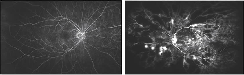 Figure 7. Ultra-widefield fluorescein angiography in an eye with minimal ischemia/leakage (left) and extensive ischemia/leakage (right). 
Images courtesy of Justis Ehlers, MD