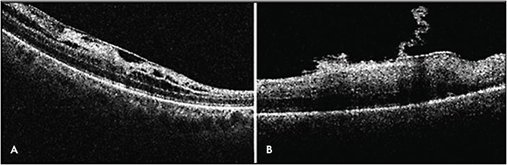 Figure 3. Microscope-integrated iOCT (Enfocus; Leica Microsystems) demonstrating epiretinal membrane in the beginning of surgery (A) and epiretinal membrane during peeling (B).