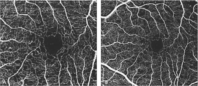 Figure 6. Swept-source OCTA imaging of the superficial capillary plexus in a diabetic retinopathy patient with preserved macular perfusion.27 Source: Hwang TS, Gao SS, Liu LL. Automated Quantification of Capillary Nonperfusion Using Optical Coherence Tomography Angiography in Diabetic Retinopathy. JAMA Ophthalmology. 2016;134(4):367-73.