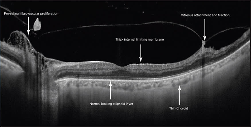 Figure 6. Swept Source OCT of proliferative diabetic retinopathy demonstrating details of fibrovascular proliferation and vitreous traction.
IMAGE COURTESY PROF. P.E. STANGA, MANCHESTER ROYAL EYE HOSPITAL, MANCHESTER VISION REGENERATION LAB AT NIRH, WELCOME TRUST MANCHESTER CRF, UNIVERSITY OF MANCHESTER, MANCHESTER, UK.