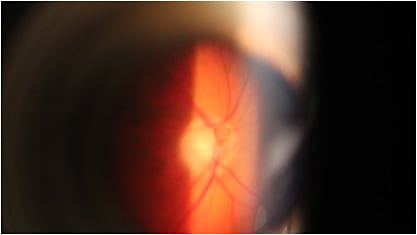 Figure 1. Dense central floater that may be amenable to laser treatment.