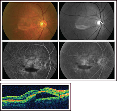 Figure 2. Images from an eye with basal laminar drusen misdiagnosed as wet age-related macular degeneration and unresponsive to treatment with anti–vascular endothelial growth factor injections. The patient had a serous detachment with hyperfluorescence and hypofluorescence on the fluorescein angiogram misinterpreted as leakage and hemorrhage. The clinical examination shows the pseudohypopyon without hemorrhage.
Images courtesy of David S. Boyer, MD