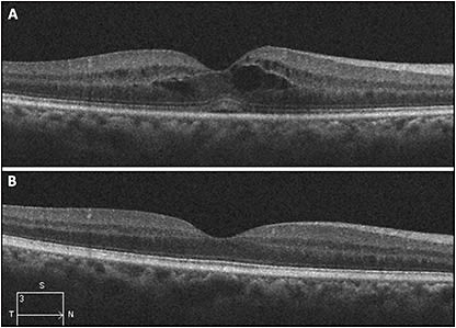 Figure 5. 54-year-old male with bilateral anterior uveitis and underlying ankylosing spondylitis. His anterior chamber inflammation responded to prednisolone acetate; however, he had persistent macular edema (A) which resolved in 1 month with a short course of prednisone starting at 60 mg daily (B).