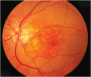 Figure 2. Fundus photo of the left macula showing dry AMD with geographic atrophy, pigmentary changes, and reticular pseudodrusen.