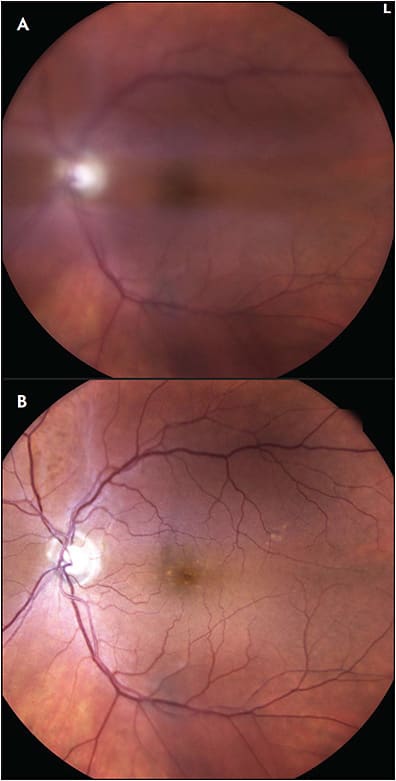 Figure 1.  Fundus photo of OS on day of Prokera placement (A) for 3 days and fundus photos of same eye (B) 2 weeks after removal. The improvement in image quality after Prokera placement is corroborated by improvement in VA from 20/60 (A) to 20/30 (B).