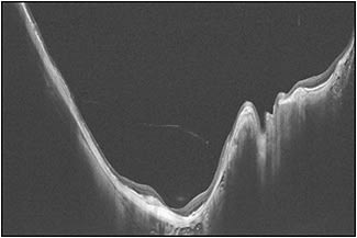 Figure 5. Ultra-widefield OCT image of an eye with pathologic myopia. Scleral curvature is observed in a very wide range (16 mm wide and 5 mm deep), wide enough to cover the entire extent of wide staphyloma.