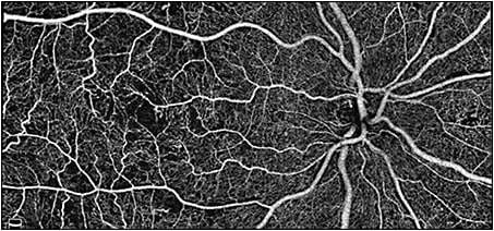 AngioVueHD Montage automatically combines 2 high-density images in a 10 mm x 6 mm field of view. IMAGE COURTESY OF ADIL EL MAFTOUHI, OD, LYON, FRANCE.
