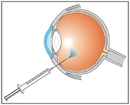 Figure 2: Illustration of the device and/or application procedure