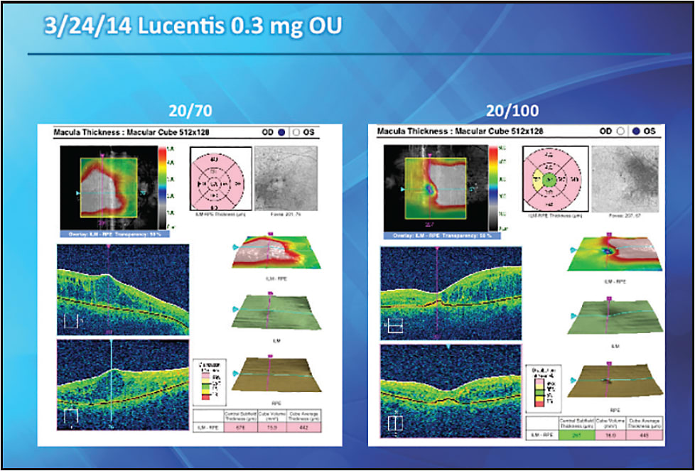 FIGURE 1. The patient received ranibizumab in each eye at this visit.