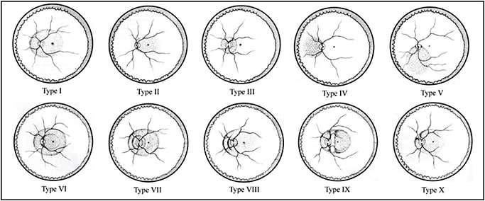 Figure 6. Curtin’s classification of posterior staphyloma. Types I through V are classified as primary staphyloma, and types VI through X are classified as combined staphyloma. The latter is a combination of primary staphylomas.