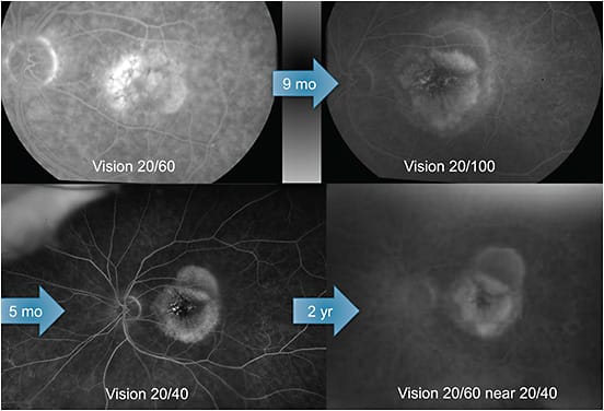 Figure 1: The progression from the initial leakage (top left) to 9 months later after treatment with aflibercept alone (upper right). Bottom left is after steroid+PDT. Bottom right, 2 years later.