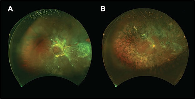 Figure 3. Widefield fundus photography (Optos) displaying a tractional retinal detachment with marked traction in the macula and peripapillary regions (A). Postoperative widefield fundus photography showing reattachment of the retina with silicone oil and endolaser in the retinal periphery (B). Images courtesy of Dr. Luis Haddock.