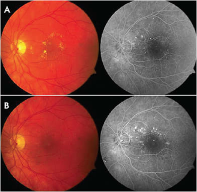 Figure 1. Color fundus photo and FA of the left eye at the initial visit (A). The color fundus photo shows a circinate pattern of hard exudates associated with DME. The FA shows focal DME associated with focal leaky microaneurysms. In color fundus photos and FA of the same eye approximately 5 months after focal laser photocoagulation, the exudates have disappeared, and DME has decreased (B). FA shows staining of the laser scars.