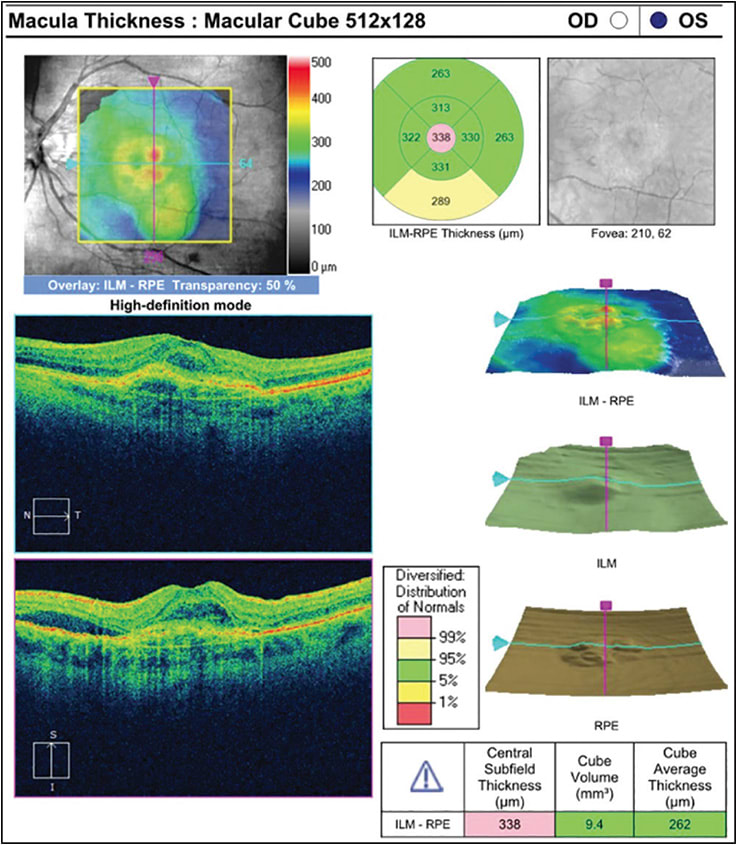 Figure 2.  Optical coherence tomography of the left eye, revealing a fibrovascular pigment epithelial detachment and subretinal fluid.