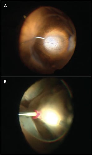 Figure 6. Phacovitrectomy in the setting of complex posterior-segment pathology. Shallow serous retinal detachment associated with a small choroidal melanoma prior to endolaser thermotherapy (A). Total serous retinal detachment associated with a large choroidal melanoma during transvitreal fine-needle aspiration biopsy (B).