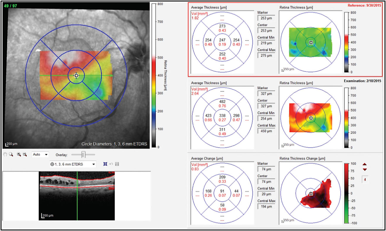 Figure 1. Prior to Iluvien implantation OD, despite frequent steroid treatments, DME recurred.