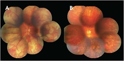 Figure 6. Progressive outer retinal necrosis with confluent retinitis and necrosis. Diffuse retinal pigment mottling with retinal atrophy remain after treatment (B). FIGURE REPRINTED WITH PERMISSION FROM ELSEVIER.1