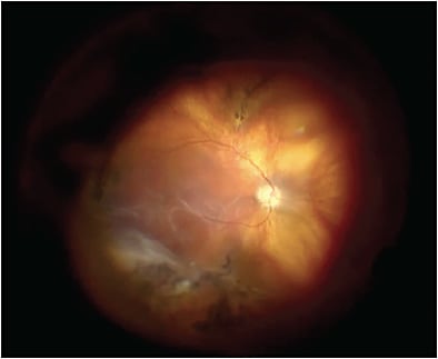 Figure 2. Left eye of a 45-year-old patient with Stickler syndrome who had a retinal detachment 30 years after a prophylactic buckle and laser. The detachment and evidence of radial lattice are visible.
