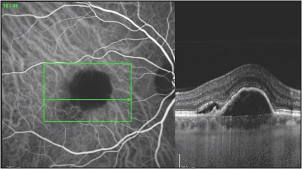 Figure 1. Indocyanine green angiography (ICGA) of polypoidal choroidal vasculopathy (PCV) lesion along the edge of a retinal pigment epithelial detachment (RPED). Note the dark hypofluorescence of the RPED on the ICGA utilizing the scanning laser ophthalmoscope and the PCV complex imaged on ICGA along the edge of the RPED.