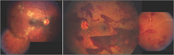 Figure 1. Fundus montage photos of the right and left eyes on initial presentation in November 1989. In the right eye, neovascularization of the disc, vascular sheathing, scattered intraretinal hemorrhages in the periphery and areas of subretinal fibrosis in the macular region are present. In the left eye, multiple areas are visible of preretinal and subhyaloid hemorrhages with neovascularization of disc and sclerosis of retinal vessels extending into the periphery.
