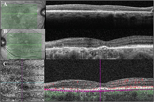 Figure 1. A 64-year-old white male referred initially for macular degeneration. Multimodal imaging helped to identify that he has chronic central serous chorioretinopathy (CSCR) of both eyes. OCT of the right eye demonstrates external limiting membrane (ELM) and ellipsoid zone (EZ) disruption, pachyvessels, and a nasal serous pigment epithelial detachment (A). OCT of the left eye demonstrates diffuse ELM and EZ disruption, and a thick choroid. There is a small double-layer sign at the level of the fovea, and thus an OCT-A was obtained to assess for CNV (B). OCT-A of left eye segmented at the level of choriocapillaris (left panel) demonstrated no neovascularization (C). Adjacent flow overlay on the cross-sectional OCT imaging demonstrates no flow in the sub-RPE space (right panel).