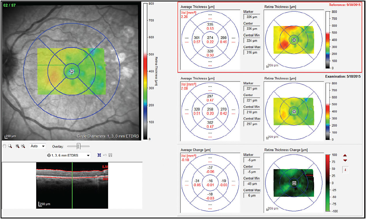 Figure 5. At 10 months after Iluvien was placed in the left eye, visual acuity and
central retinal thickness remained stable.