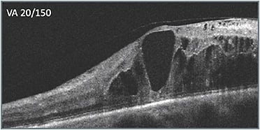 C: Ten weeks after last treatment following switch within same class