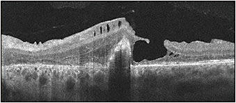 Figure 1. Macular hole caused by blunt trauma in a  22-year-old patient prior to surgery employing the inverted ILM flap technique.