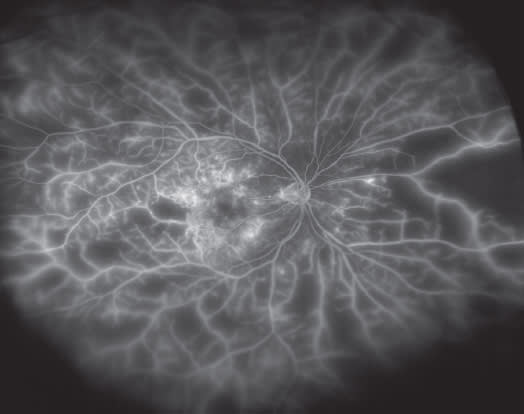 Figure 1. Ultrawidefield FA of a patient with diffuse DME with PDR and extensive peripheral capillary nonperfusion and peripheral vascular leakage.