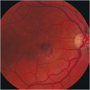 Figure 3. Fundus photo of the right macula demonstrates a choroidal neovascular membrane secondary to wet AMD.