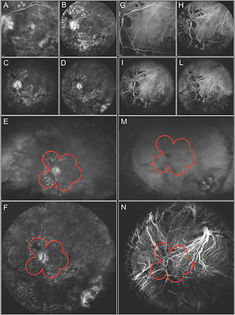 Figure 1. Fluorescein angiography (FA) and concomitant indocyanine green angiography (ICGA): 30° (A and G, respectively), 55° (B and H, respectively), 60° Ocular Lee-Mainster SLO Lens (C and I, respectively), 102° (D and L, respectively) and 150° Ocular Staurenghi contact lens (F and N, respectively). FA and ICGA performed with Optos imaging system without the need for a contact lens to obtain 120° on the horizontal axis and 80° on the vertical axis (E and M, respectively). The red outline shows the 7-standard field view.