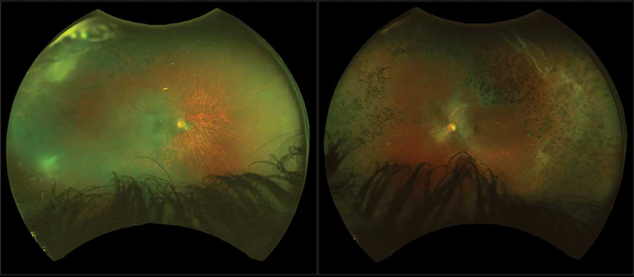 Figure 4. Widefield fundus photograph of patient with remote history of syphilis with  bilateral peripheral pigmented chorioretinal scars and unilateral bone spicules
