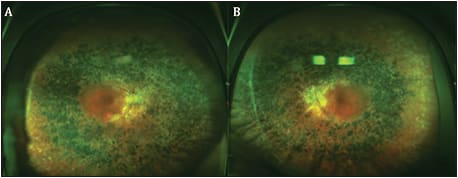 Figure 1. Fundus images of a pediatric patient with RP. There is involvement of the right (A) and left (B) eyes, with characteristic retinal pigmentary changes and arteriolar attenuation. Focal areas of blurring centrally in both eyes are secondary to the presence of posterior subcapsular cataracts, commonly present in retinitis pigmentosa.