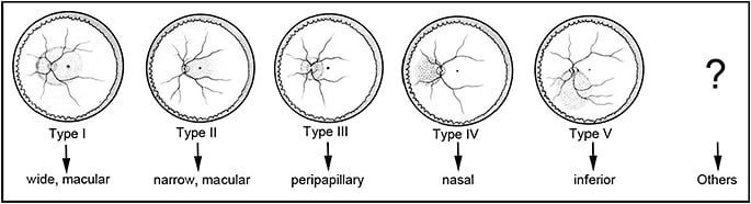 Figure 7. The author’s classification of posterior staphyloma. Only the contour of the outermost staphyloma border is considered. This results in the Curtin types VI to X being placed into the type I category. Also, the staphyloma type has been renamed based on its location and distribution; this facilitates memorization.