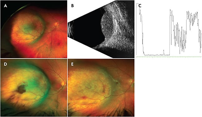 Figure 3. A 14-year-old female with a long-standing history of strabismus status-post surgical correction was seen for routine follow-up was found to have a decline in vision (20/30). A dome-shaped, lightly pigmented choroidal mass centered at the 7-o’clocl position just anterior to the equator measuring 16.5 mm x 15.5 mm x 7.5 mm was observed (A). There was a surrounding, shallow exudative retinal detachment. B-scan and A-scan echography of the lesion showed low-to-medium reflectivity suggestive of choroidal melanoma (B, C). Transvitreal fine-needle aspiration biopsy using 25-gauge trocar was performed. A small area of hemorrhage on the site of puncture (D) resolved during the next few weeks (E). Cytology showed atypical cells derived from a spindle-cell neoplasm consistent with melanoma.