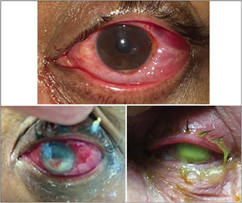 Figure 5. External photograph of eyes with traumatic endophthalmitis, at different levels of severity, showing diffuse hemorrhagic chemosis, hypopyon and periorbital edema, and erythema.