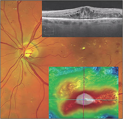 Figure 1. Diabetic macular edema and macular lipid exudates, left eye, in a patient with proliferative diabetic retinopathy (retinal neovascularization elsewhere is outside of the image frame). The top insert shows spectral-domain optical coherence tomography (SD-OCT) of the macula, demonstrating cystoid foveal edema and a shallow serous foveal detachment. The bottom insert shows the SD-OCT internal limiting membrane-retinal pigment epithelium slab topographic image of the macula; the maximum retinal thickness is in the central macula. The foveal clivus is absent due to the edema.